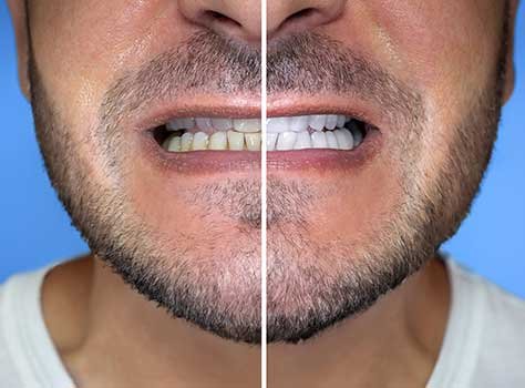 Dental Implants in Kokapet