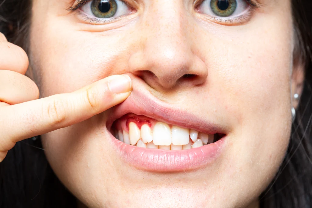 Bleeding Gums