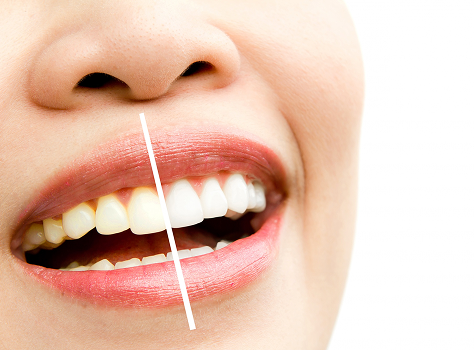 Composite Fillings in Kokapet