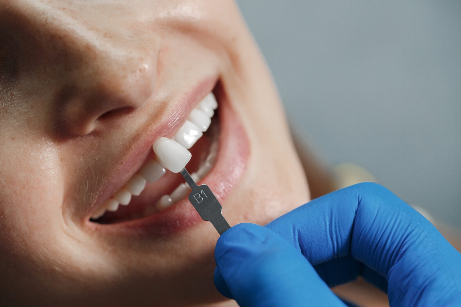 dental veneers in kokapet