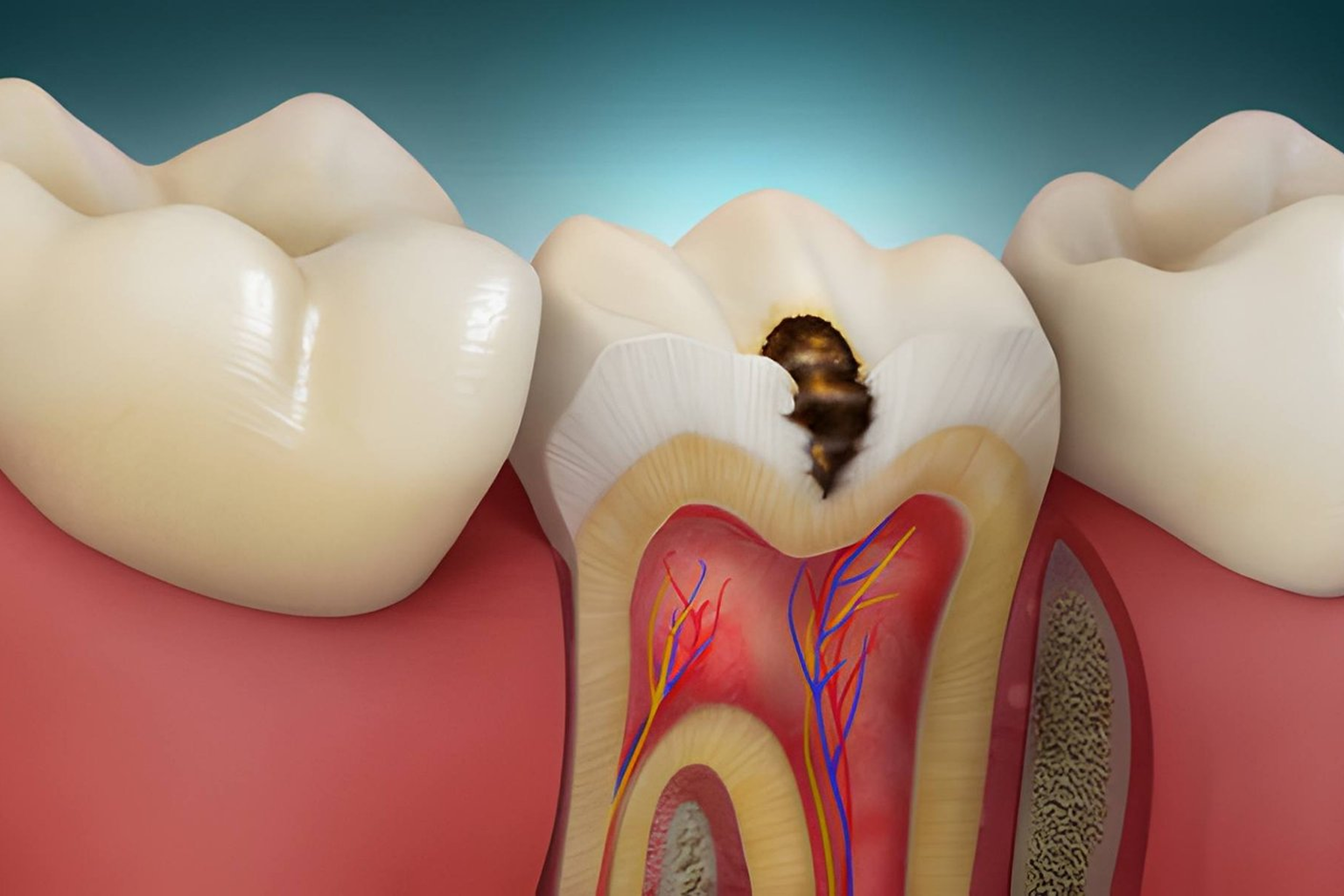 Composite Fillings in Kokapet