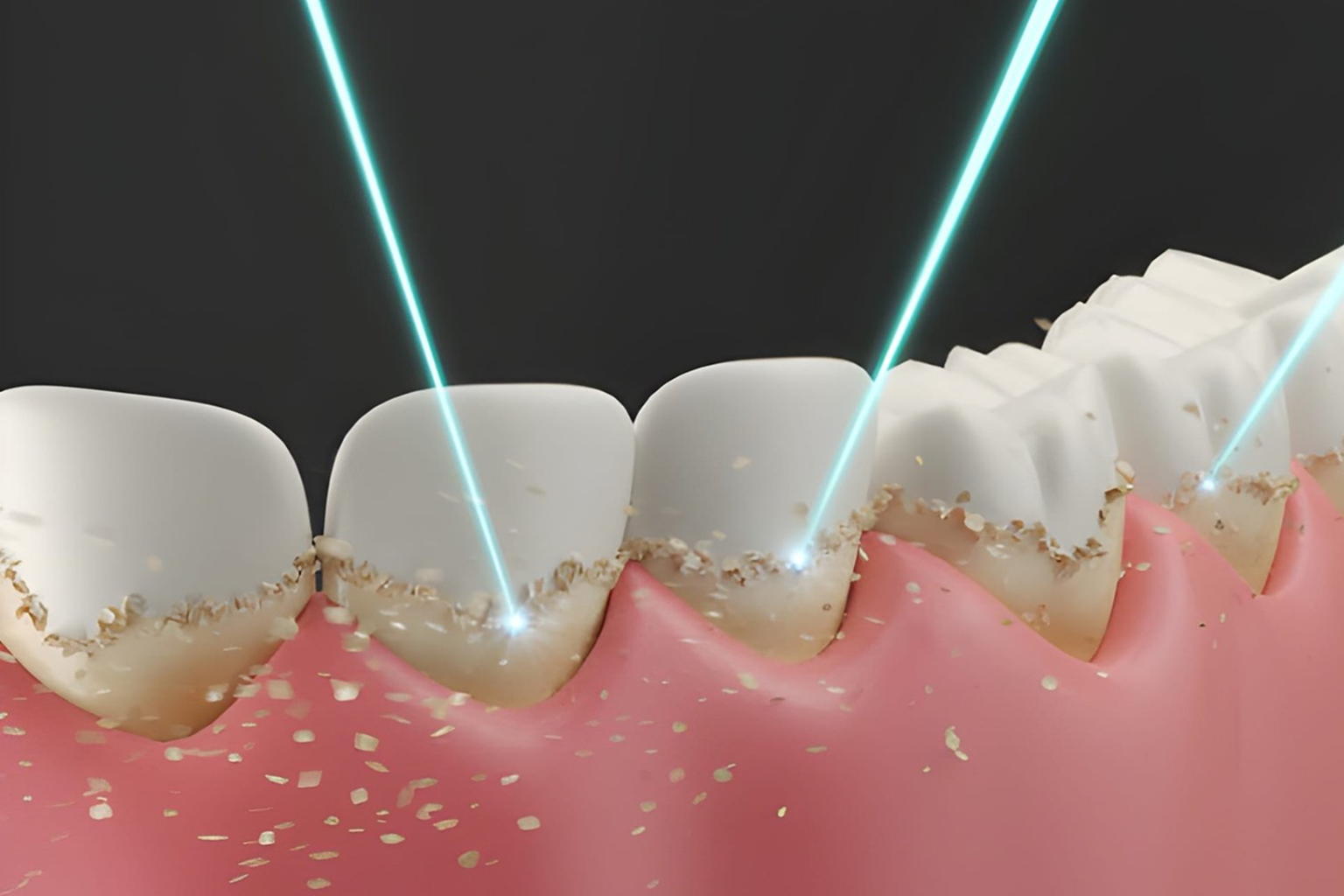 laser dentistry in kokapet