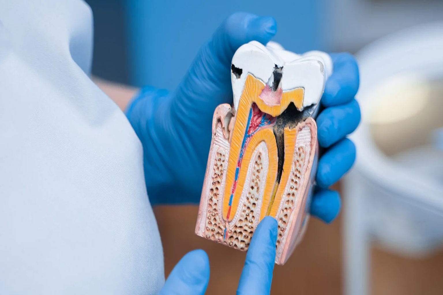 Laser Root Canal in kokapet