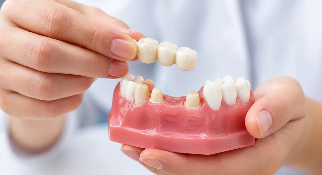 Dental bridges in Kokapet
