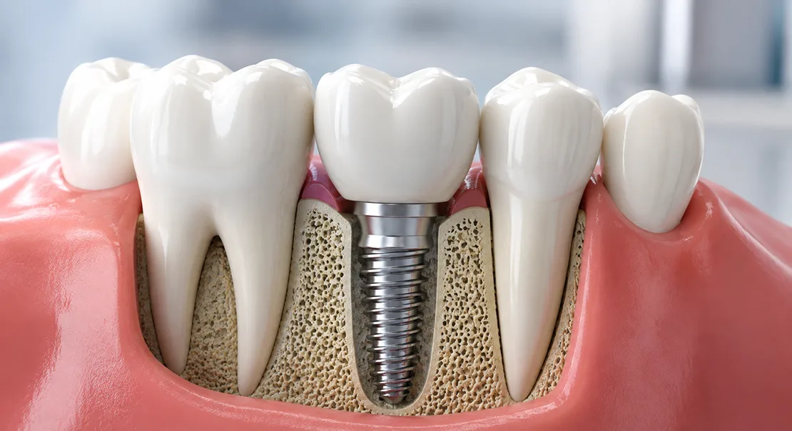 Dental Implants in Kokapet