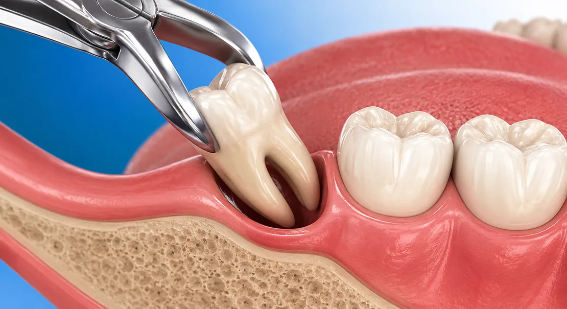 wisdom tooth extraction in kokapet