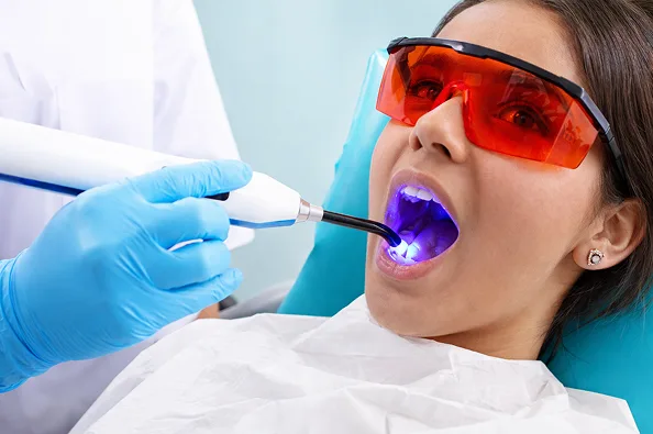 Composite Fillings in Kokapet